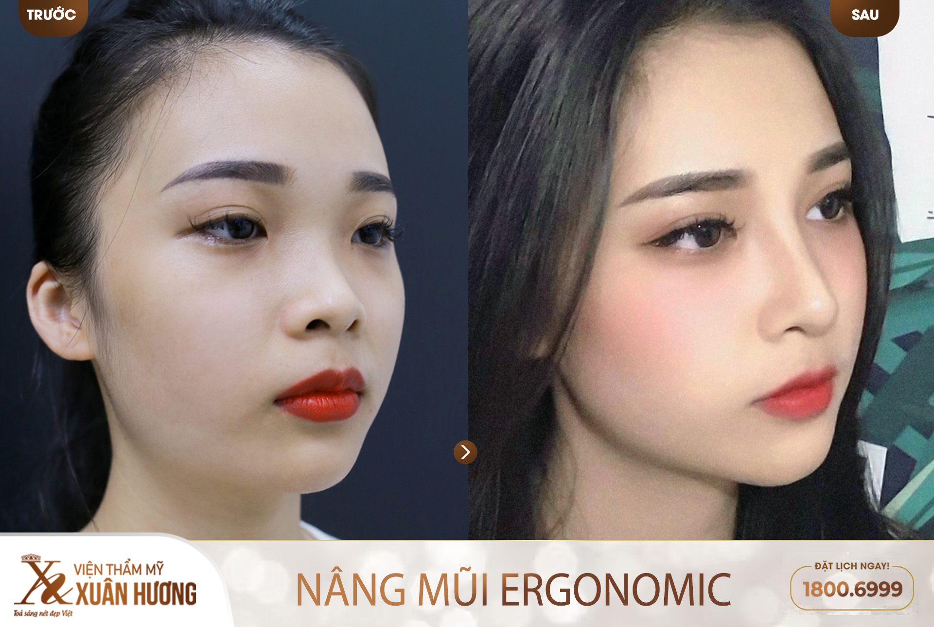 Kết quả nâng mũi Ergonomic 