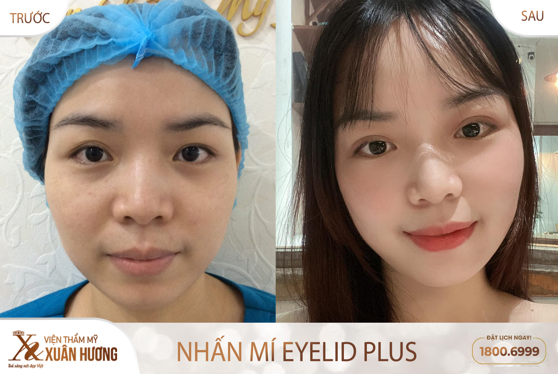 dịch vụ nhấn mí Eyelid Plus