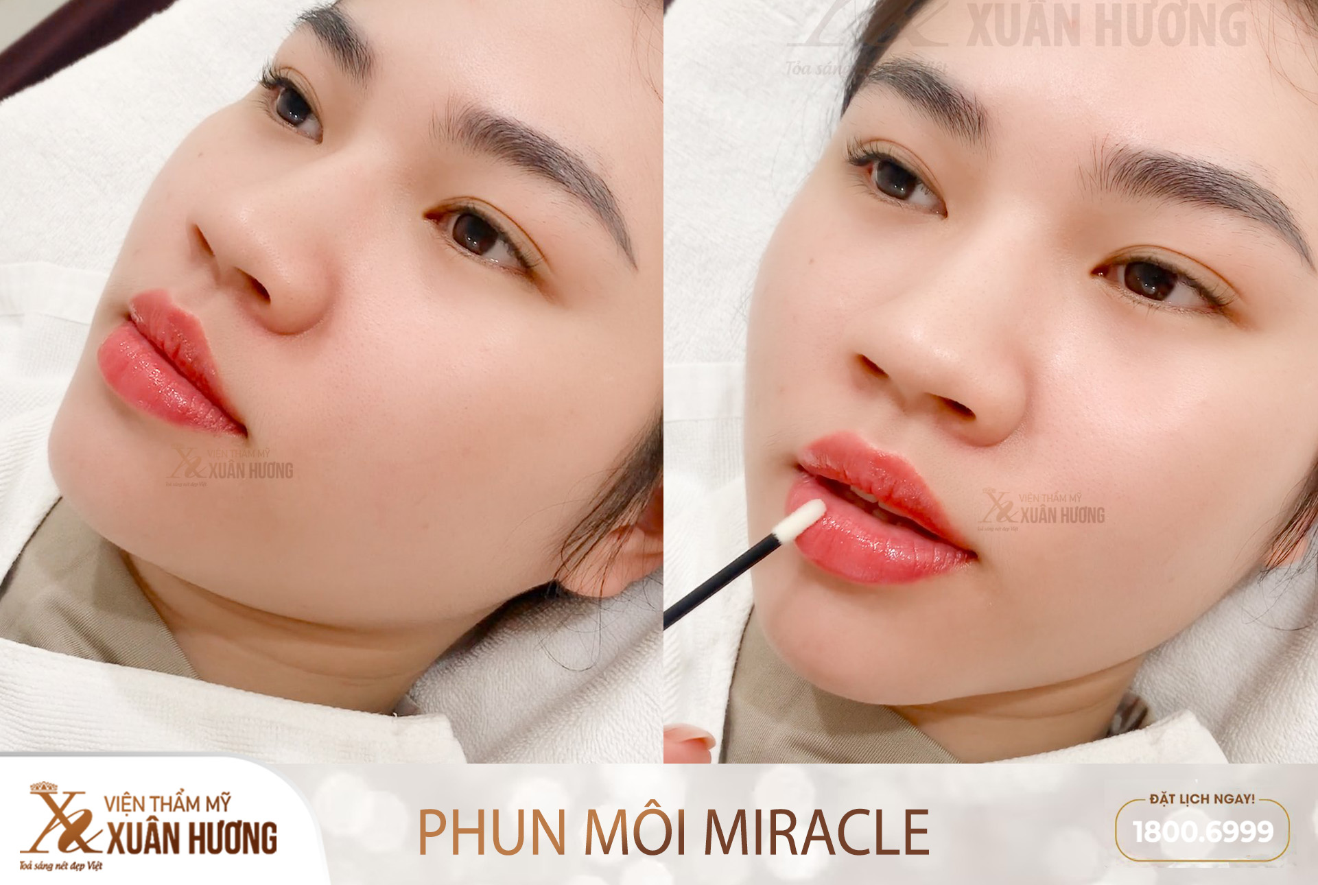 Phun môi Miracle có đau không