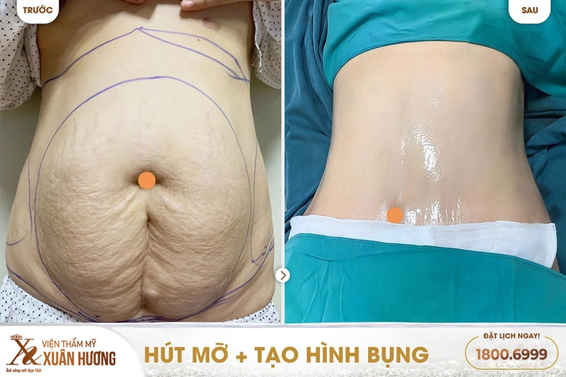 hút mỡ và tạo hình thành bụng