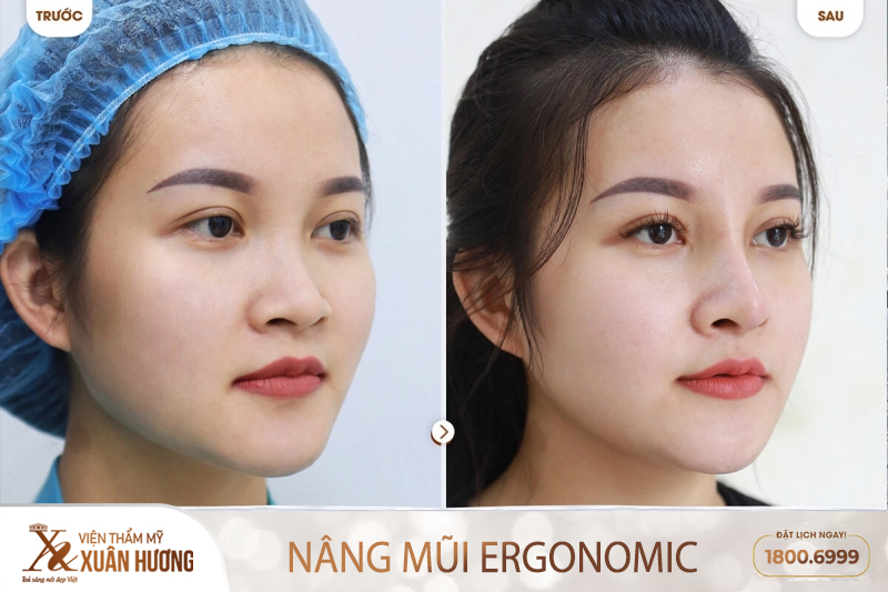 trước và sau nâng mũi tại Viện thẩm mỹ Xuân Hương