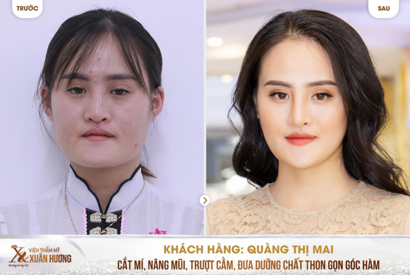 Khách hàng sau khi làm đẹp cùng viện thẩm mỹ xuân hương