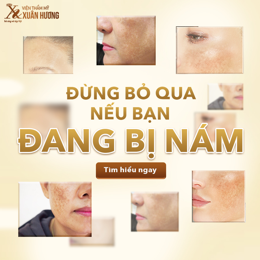 Trị nám Melas Peeling 3in1