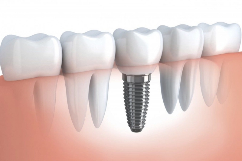 Cấy ghép răng implant