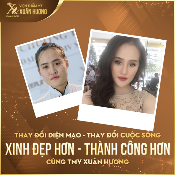 kết quả sau thẩm mỹ tại Xuân Hương