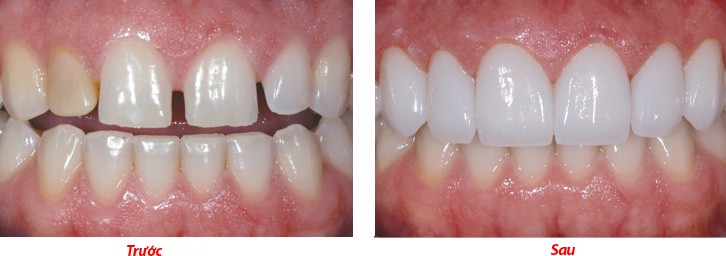 gắn răng sứ Ceramill