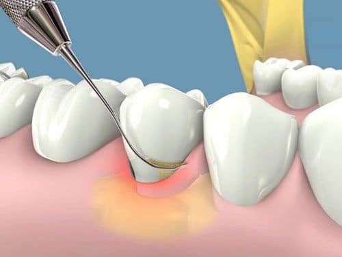 lấy cao răng và tẩy trắng