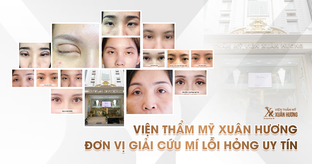 giải cứu mí hỏng lỗi tại Viện Thẩm Mỹ Xuân Hương