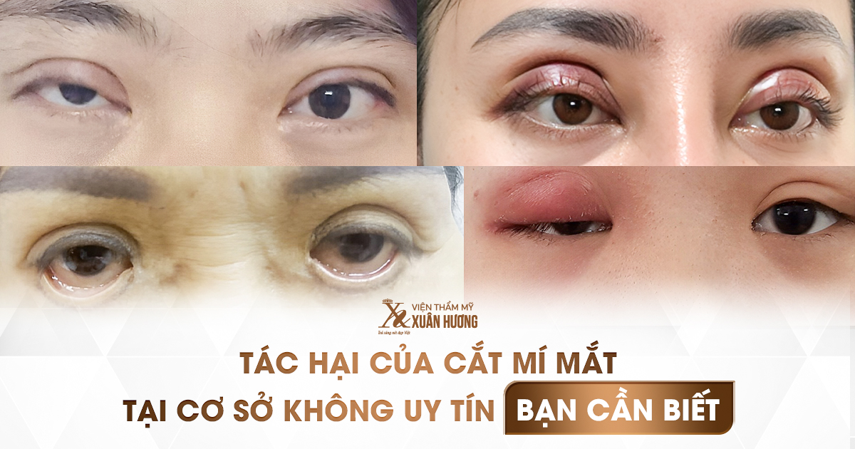 tác hại của cắt mí tại cơ sở không uy tín