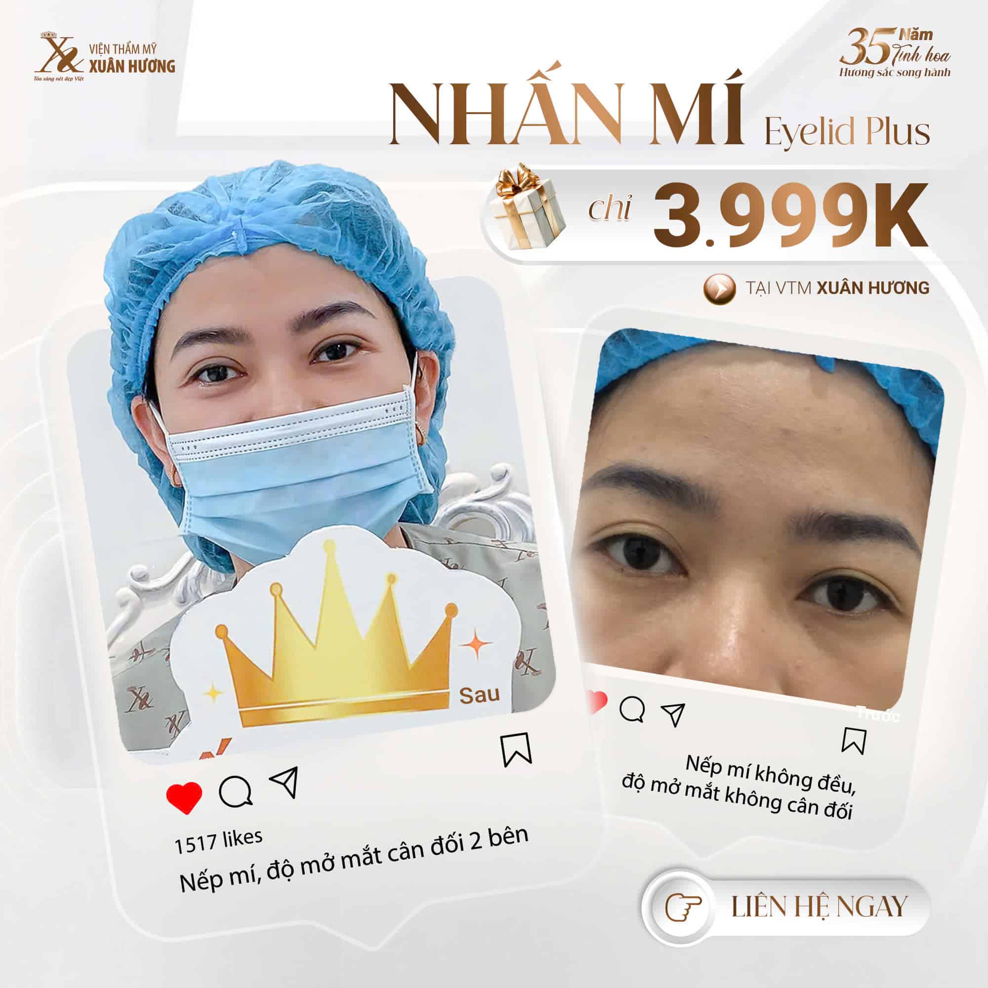 nhấn mí mắt đẹp đẹp tại VTM Xuân Hương