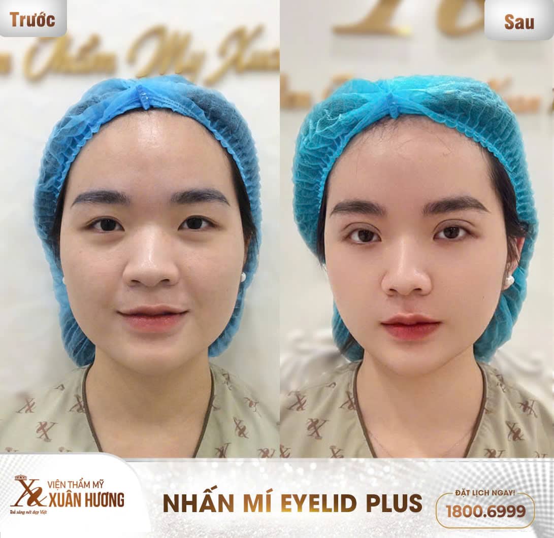 nhấn mí mắt đẹp tại Xuân Hương