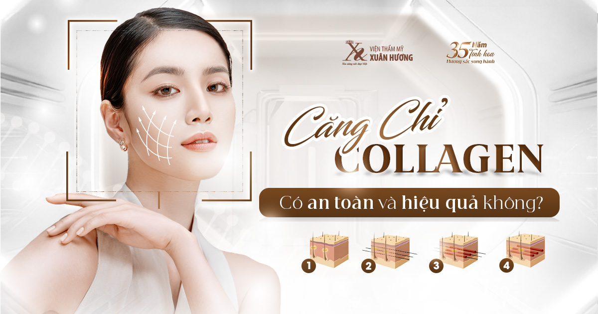 căng chỉ collagen